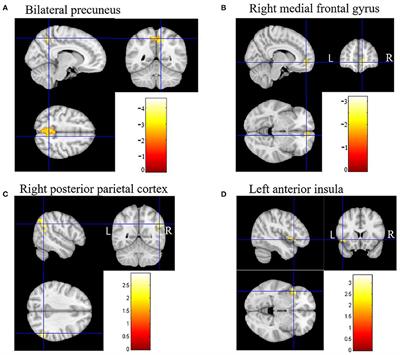 Changes in Brain Function Networks in Patients With Amnestic Mild Cognitive Impairment: A Resting-State fMRI Study